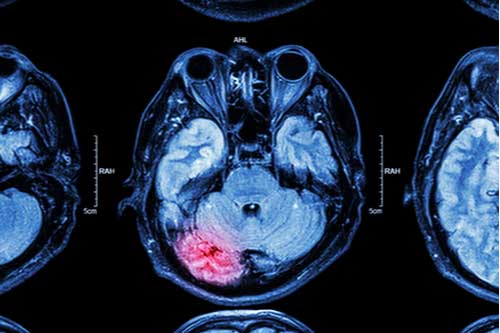 MRI scan of brain injury Smyrna brain injury lawyer concept